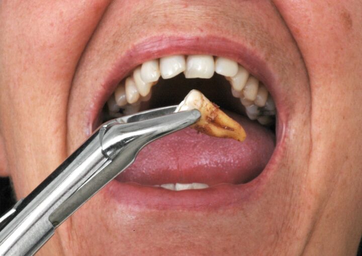 Diş çekimi sonrası iyileşme sürecini gösteren ağız içi değerlendirme görüntüsü.