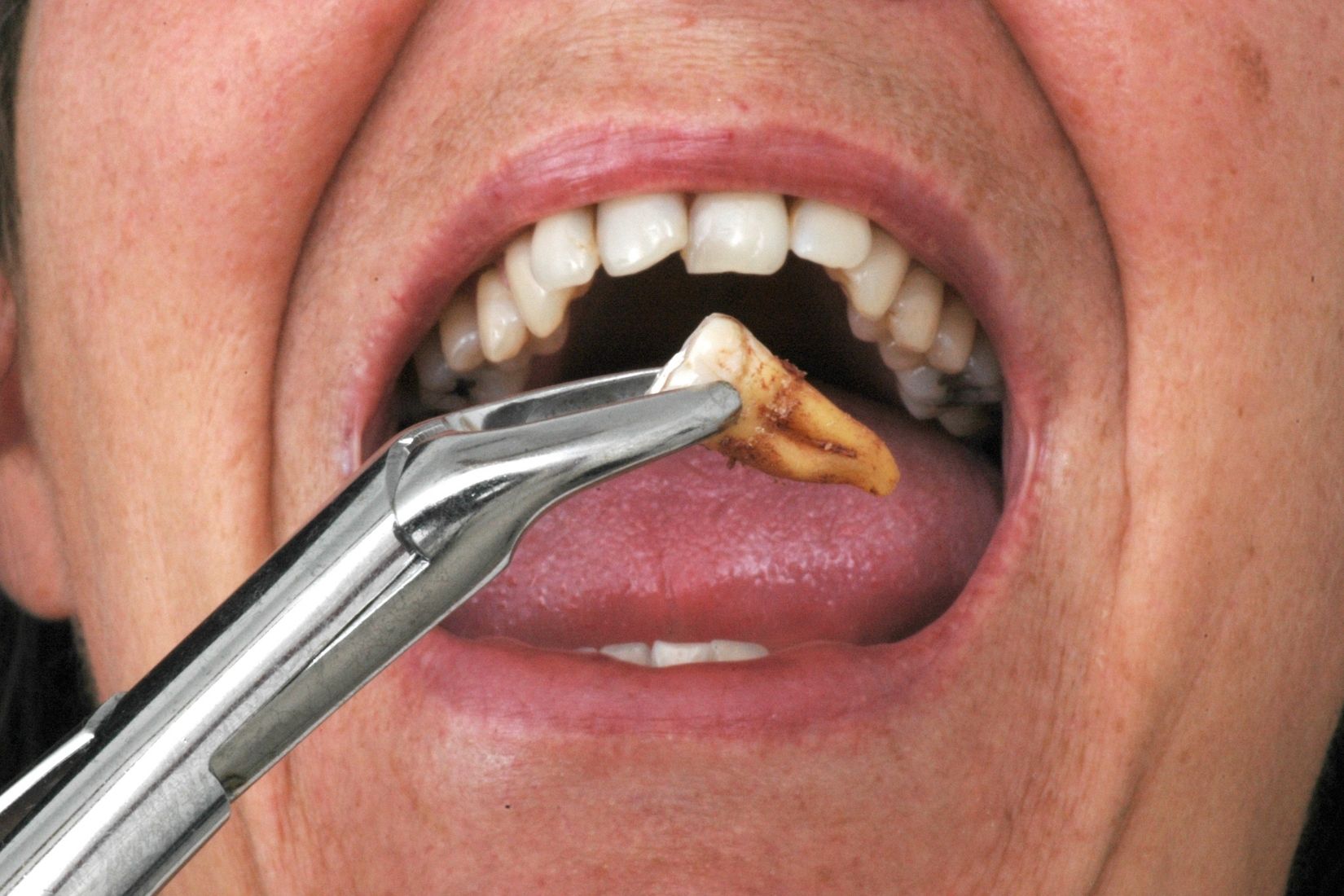 Diş çekimi sonrası iyileşme sürecini gösteren ağız içi değerlendirme görüntüsü.