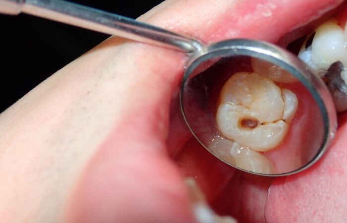 Diş dolgusu sonrası diş ve dolgu bölgesinin detaylı ağız içi görüntüsü.