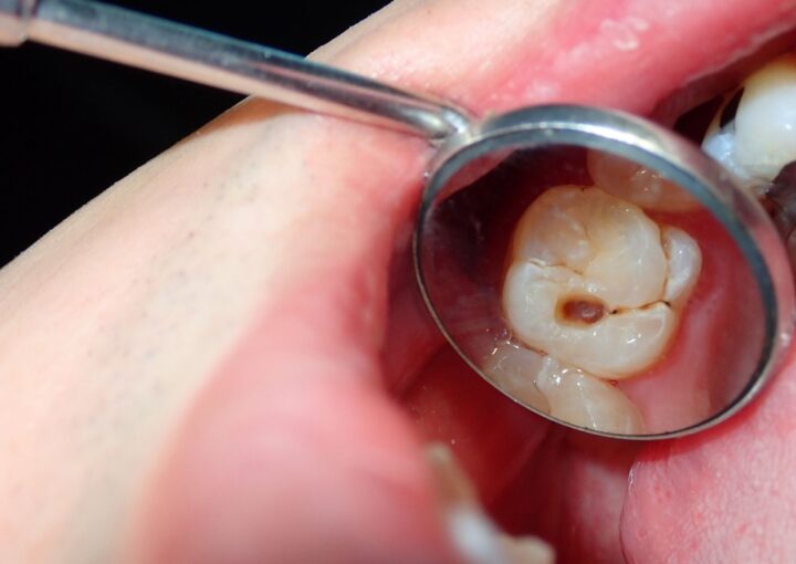 Diş dolgusu sonrası diş ve dolgu bölgesinin detaylı ağız içi görüntüsü.