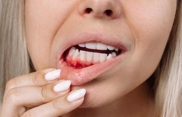 Diş eti kanamasını gösteren ağız içi muayene görüntüsü.