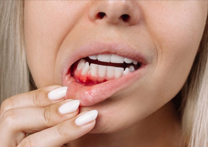 Diş eti kanamasını gösteren ağız içi muayene görüntüsü.