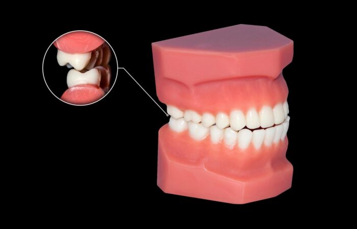 Gece diş gıcırdatmayı önlemek için takılan şeffaf plak kullanan yetişkin bir hastanın dişlerinin yakın çekim görüntüsü.