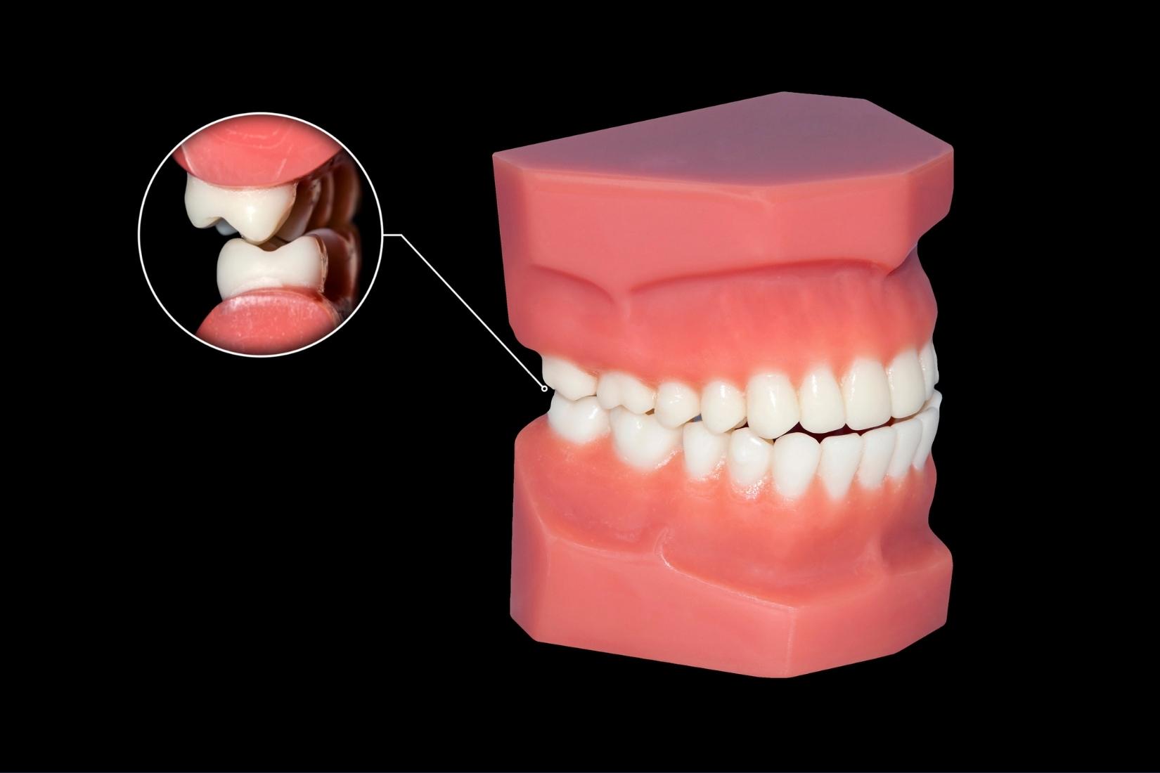 Gece diş gıcırdatmayı önlemek için takılan şeffaf plak kullanan yetişkin bir hastanın dişlerinin yakın çekim görüntüsü.