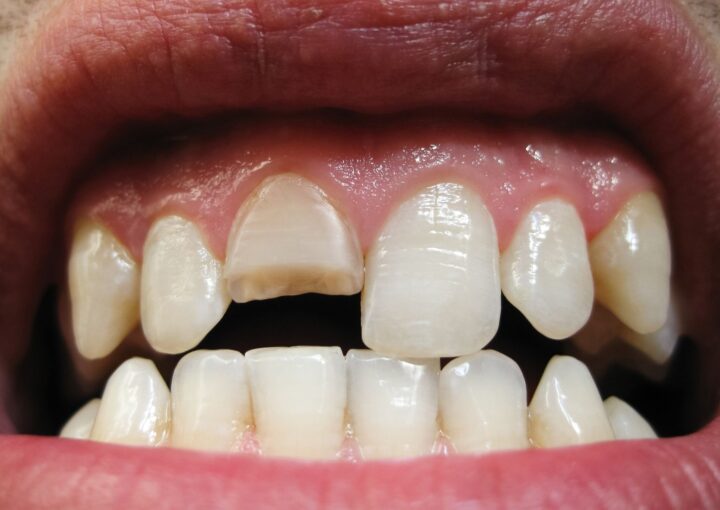 Kırık dişin ağız içindeki görünümünü gösteren detaylı dental görüntü.