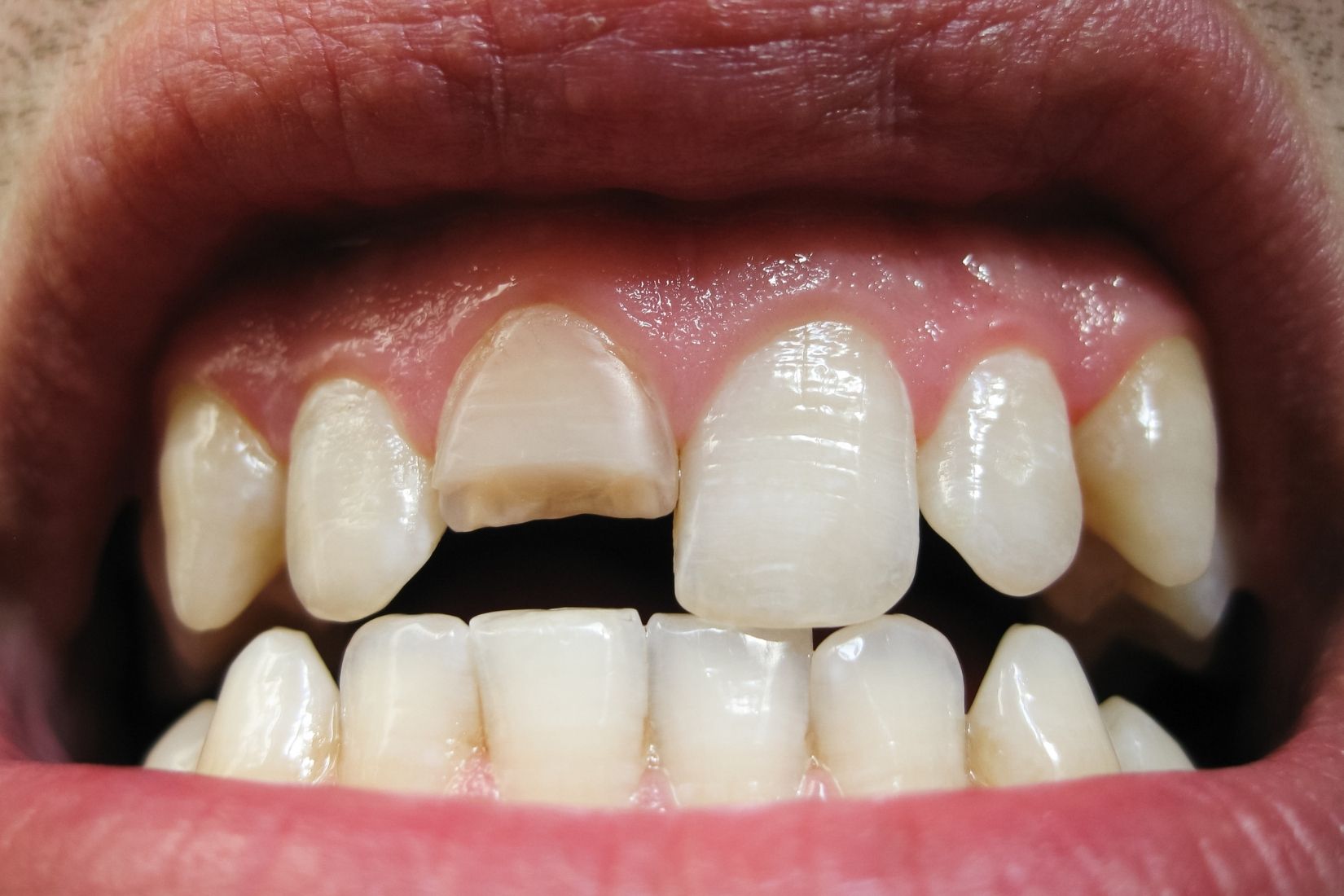 Kırık dişin ağız içindeki görünümünü gösteren detaylı dental görüntü.