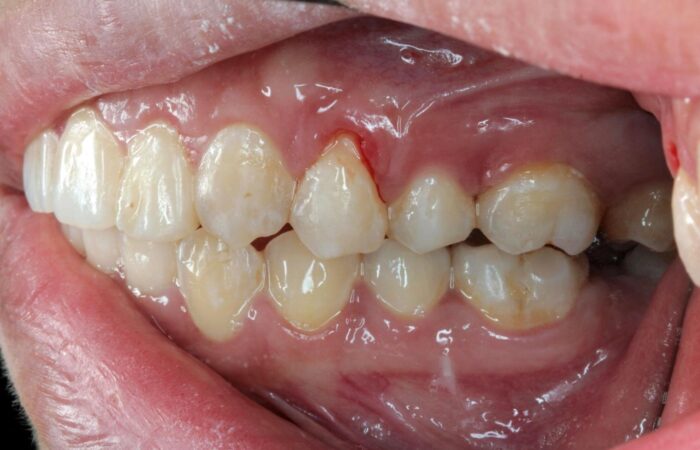 Diş eti çekilmesini ve kök yüzeyinin açığa çıkmasını gösteren ağız içi detay görseli.