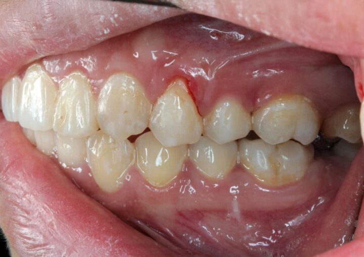 Diş eti çekilmesini ve kök yüzeyinin açığa çıkmasını gösteren ağız içi detay görseli.