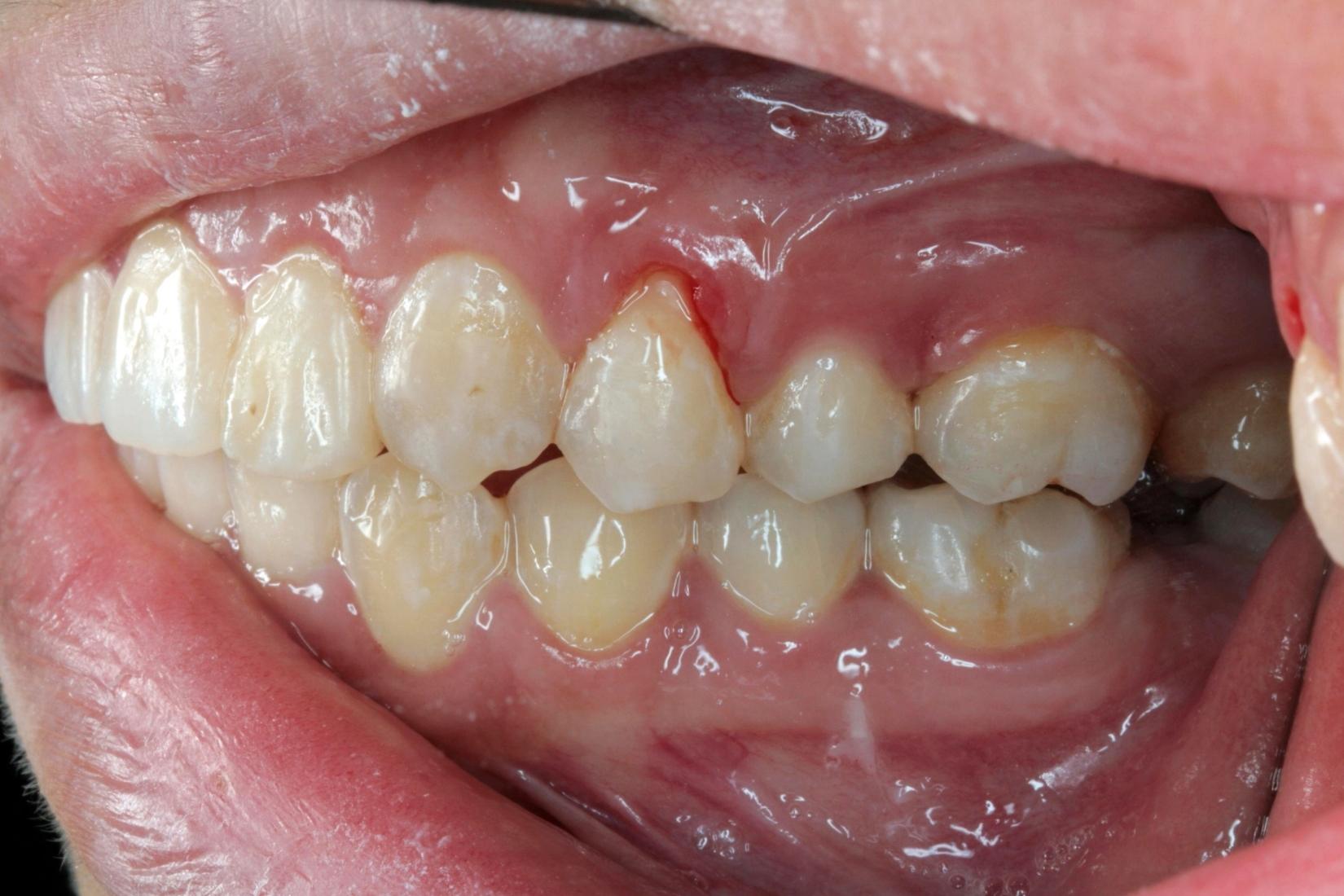 Diş eti çekilmesini ve kök yüzeyinin açığa çıkmasını gösteren ağız içi detay görseli.