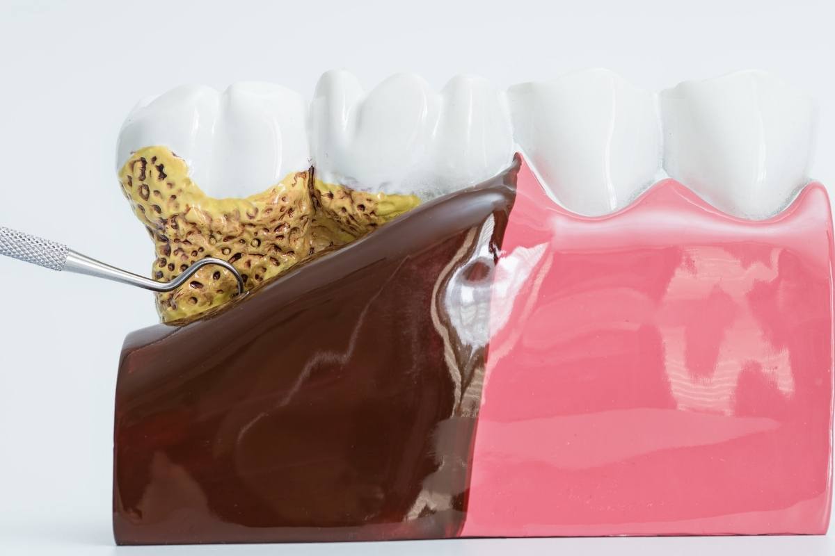 Diş eti iltihabı ve kalp sağlığı ilişkisini anlatan ağız içi ve dolaşım temalı tıbbi görsel.