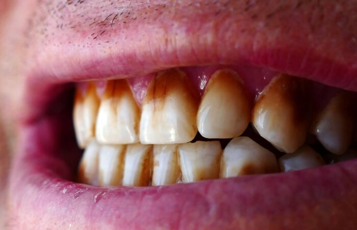 Diş yüzeylerinde çay ve kahve kaynaklı renklenmeleri gösteren ağız içi detay görüntüsü.