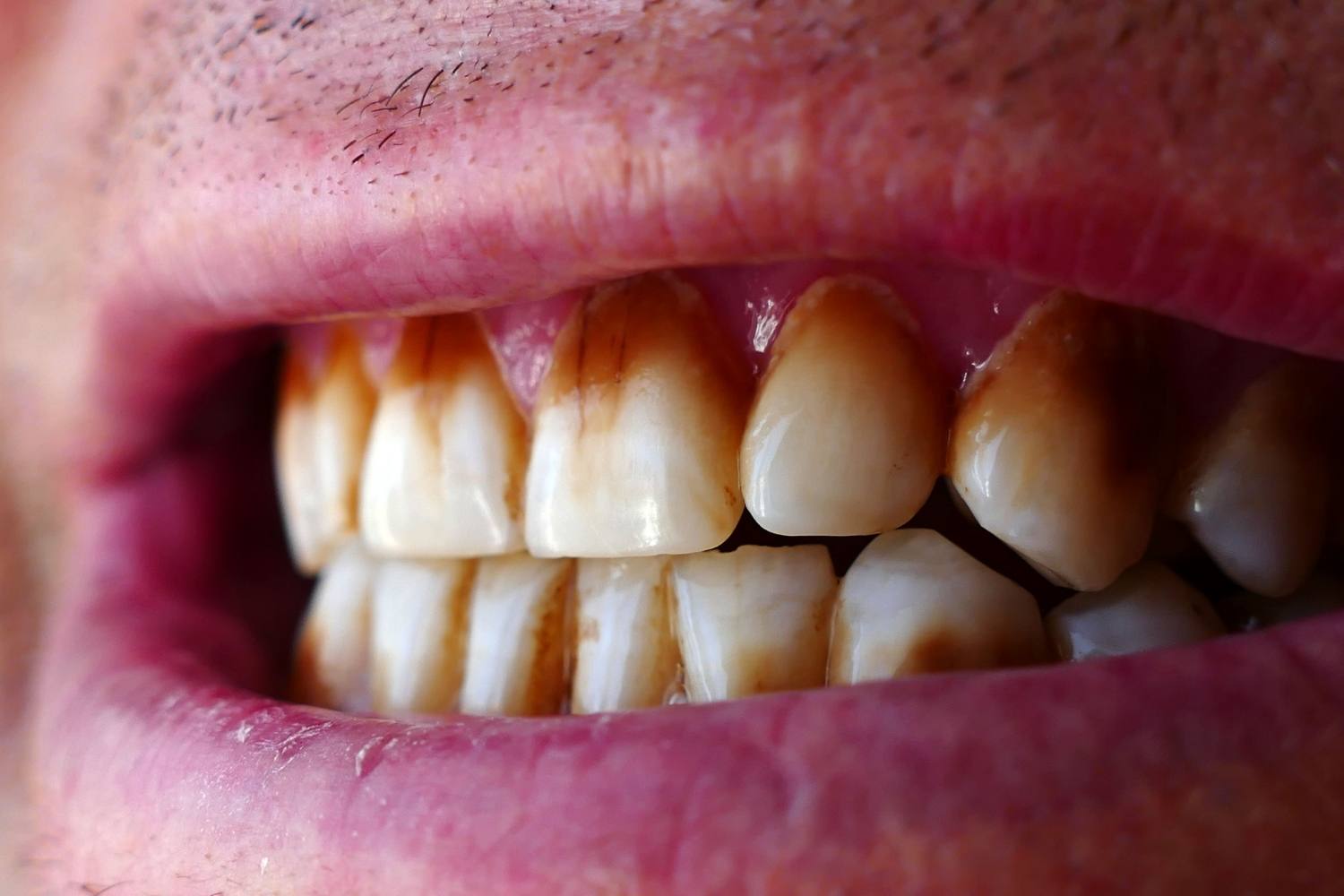 Diş yüzeylerinde çay ve kahve kaynaklı renklenmeleri gösteren ağız içi detay görüntüsü.