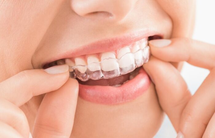 Ortodontik tedavide kullanılan şeffaf plakların detaylı görüntüsü.