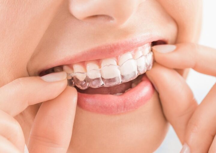 Ortodontik tedavide kullanılan şeffaf plakların detaylı görüntüsü.