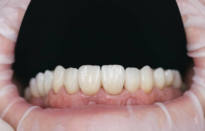 Zirkonyum diş kaplama uygulanmış doğal görünümlü dişlerin ağız içi detay görüntüsü.