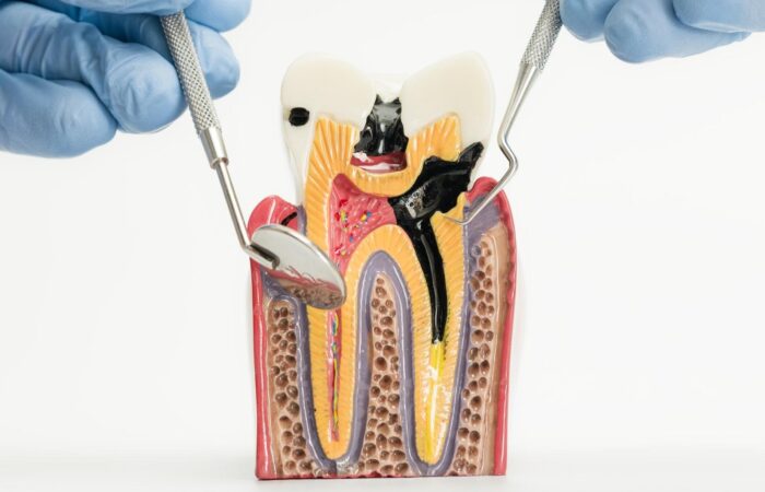 Diş çürüğünün mine, dentin ve pulpa evrelerini gösteren, çürük sürecini anlatan bilgilendirici görsel.