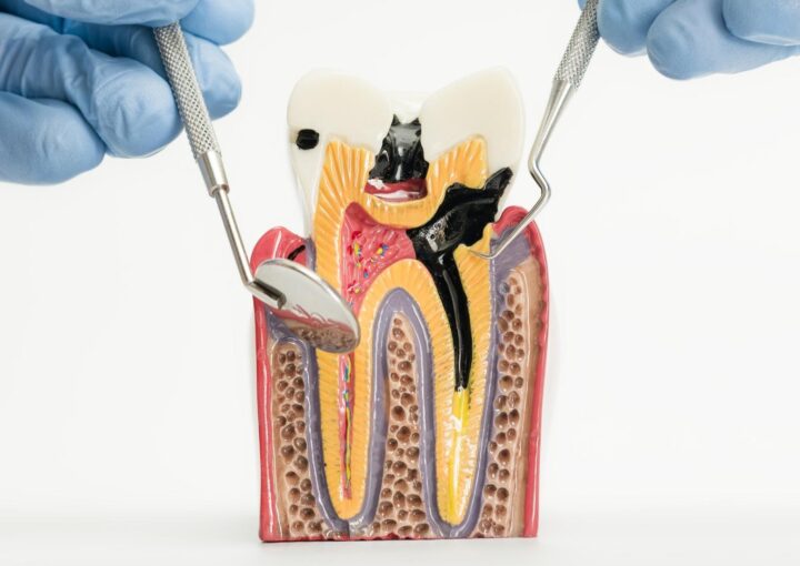 Diş çürüğünün mine, dentin ve pulpa evrelerini gösteren, çürük sürecini anlatan bilgilendirici görsel.