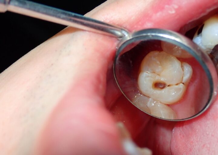 Bazı dişlerde daha hızlı gelişen çürükleri ve diş yüzeylerindeki riskli bölgeleri gösteren bilgilendirici ağız içi görsel.