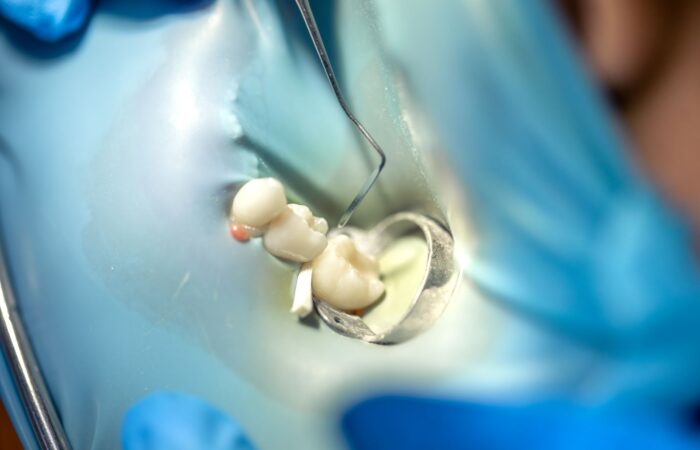 Diş dolgusu sonrası sıcak ve soğuk gıdalara karşı hassasiyet yaşayan bireyi gösteren bilgilendirici ağız sağlığı görseli.