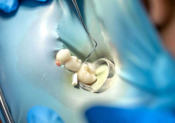 Diş dolgusu sonrası sıcak ve soğuk gıdalara karşı hassasiyet yaşayan bireyi gösteren bilgilendirici ağız sağlığı görseli.