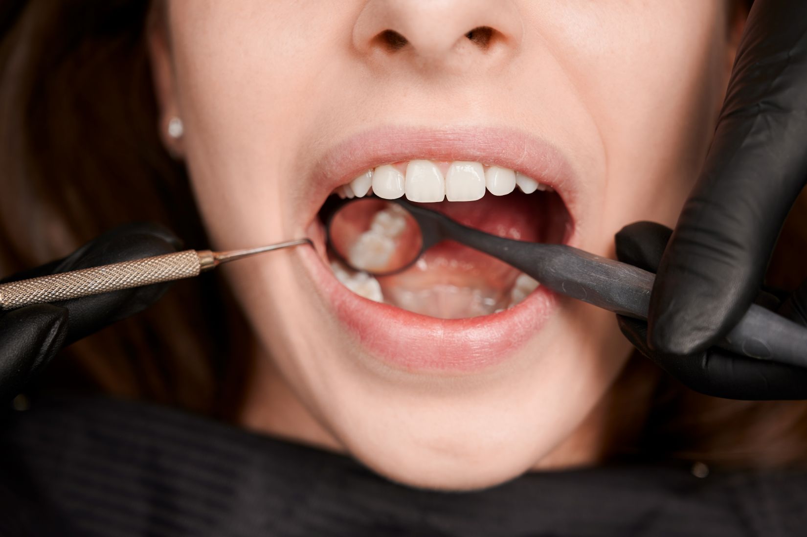 Diş eti çekilmesi sonucu diş köklerinin açığa çıktığını gösteren bilgilendirici periodontal görsel.