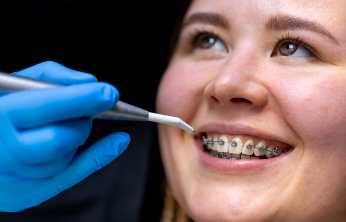 Ortodontik diş teli uygulaması ile dişlerin hizalanma sürecini gösteren diş hekimliği görseli.