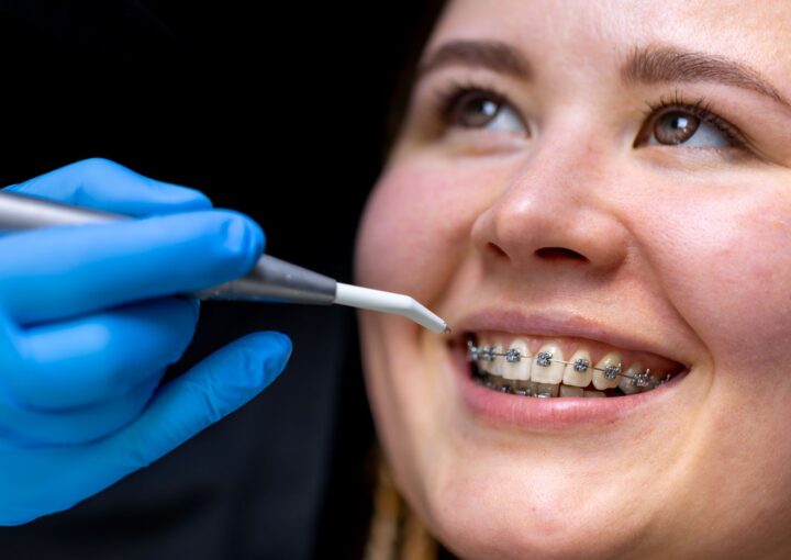 Ortodontik diş teli uygulaması ile dişlerin hizalanma sürecini gösteren diş hekimliği görseli.