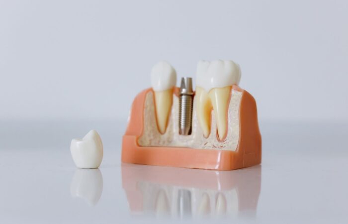 Eksik diş yerine yerleştirilen dental implantın çene kemiği içindeki konumunu gösteren diş implantı görseli.