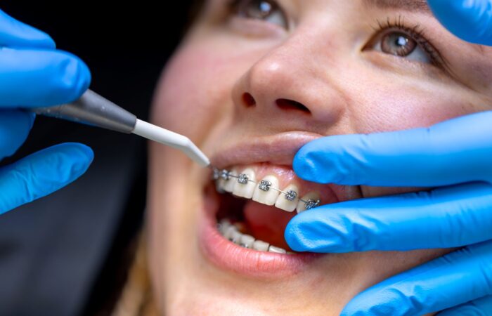 Ortodontik tedavi sonrası kullanılan retainer apareyini ve dişlerin yeni konumunu koruyan ortodontik pekiştirme cihazını gösteren görsel.