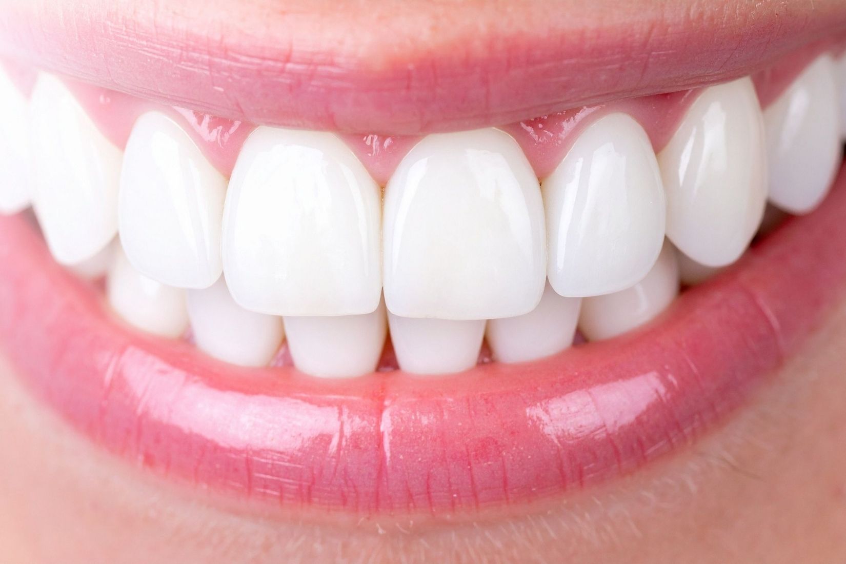 Konya gülüş tasarımı planlamasında diş estetiği ve diş eti uyumunun değerlendirildiği klinik görünüm.