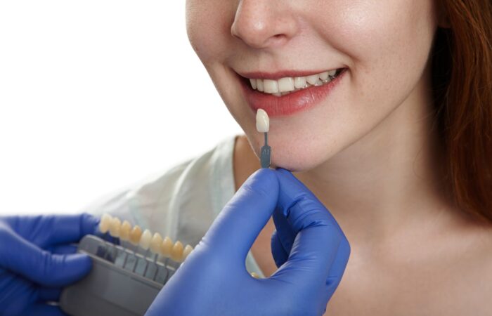 Ön dişlere uygulanan ince yaprak porselen lamina veneer kaplamaların doğal görünümünü gösteren görsel.