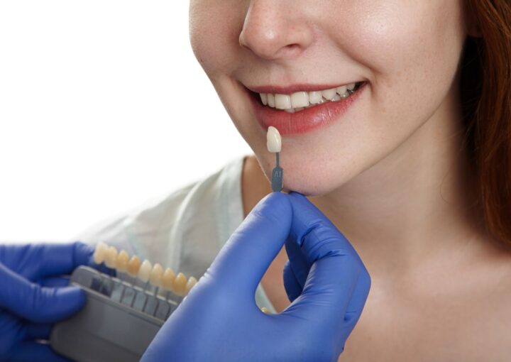 Ön dişlere uygulanan ince yaprak porselen lamina veneer kaplamaların doğal görünümünü gösteren görsel.