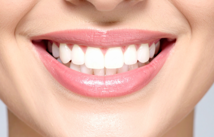 Ön diş estetiğinde kompozit bonding ve lamina veneer planlamasını gösteren bilgilendirici klinik görsel.