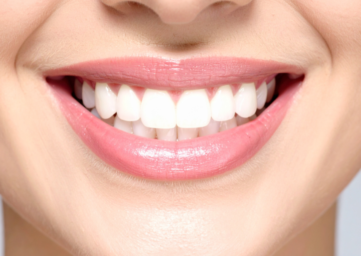 Ön diş estetiğinde kompozit bonding ve lamina veneer planlamasını gösteren bilgilendirici klinik görsel.