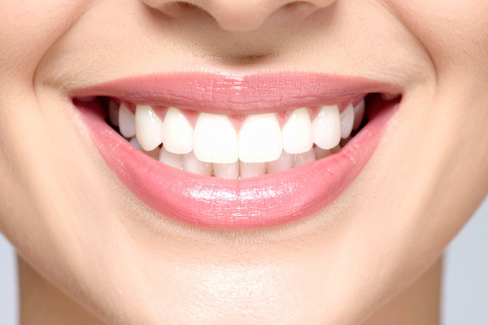Ön diş estetiğinde kompozit bonding ve lamina veneer planlamasını gösteren bilgilendirici klinik görsel.