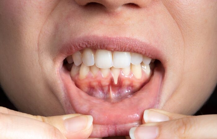 Diş eti muayenesi sırasında periodontal dokuların değerlendirildiği klinik ağız ve diş sağlığı görseli.