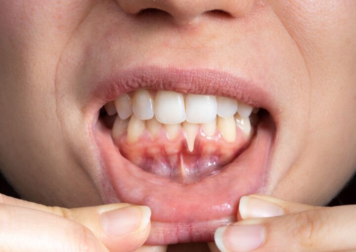 Diş eti muayenesi sırasında periodontal dokuların değerlendirildiği klinik ağız ve diş sağlığı görseli.