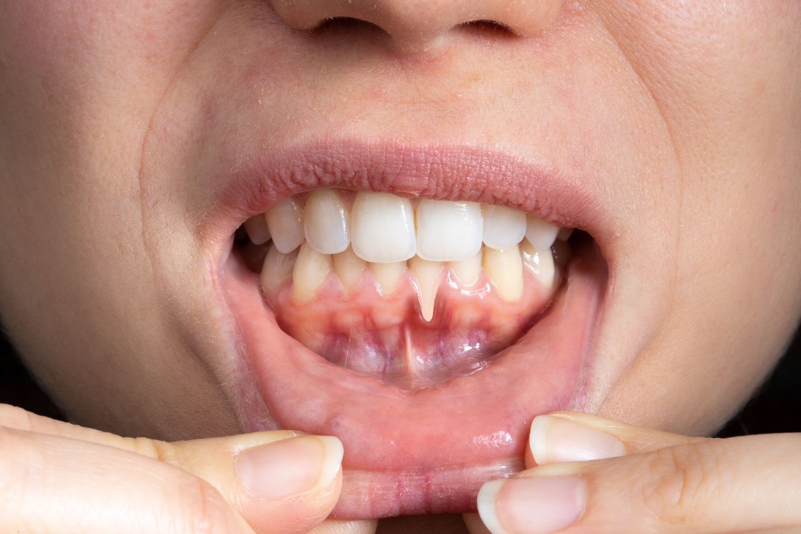 Diş eti muayenesi sırasında periodontal dokuların değerlendirildiği klinik ağız ve diş sağlığı görseli.