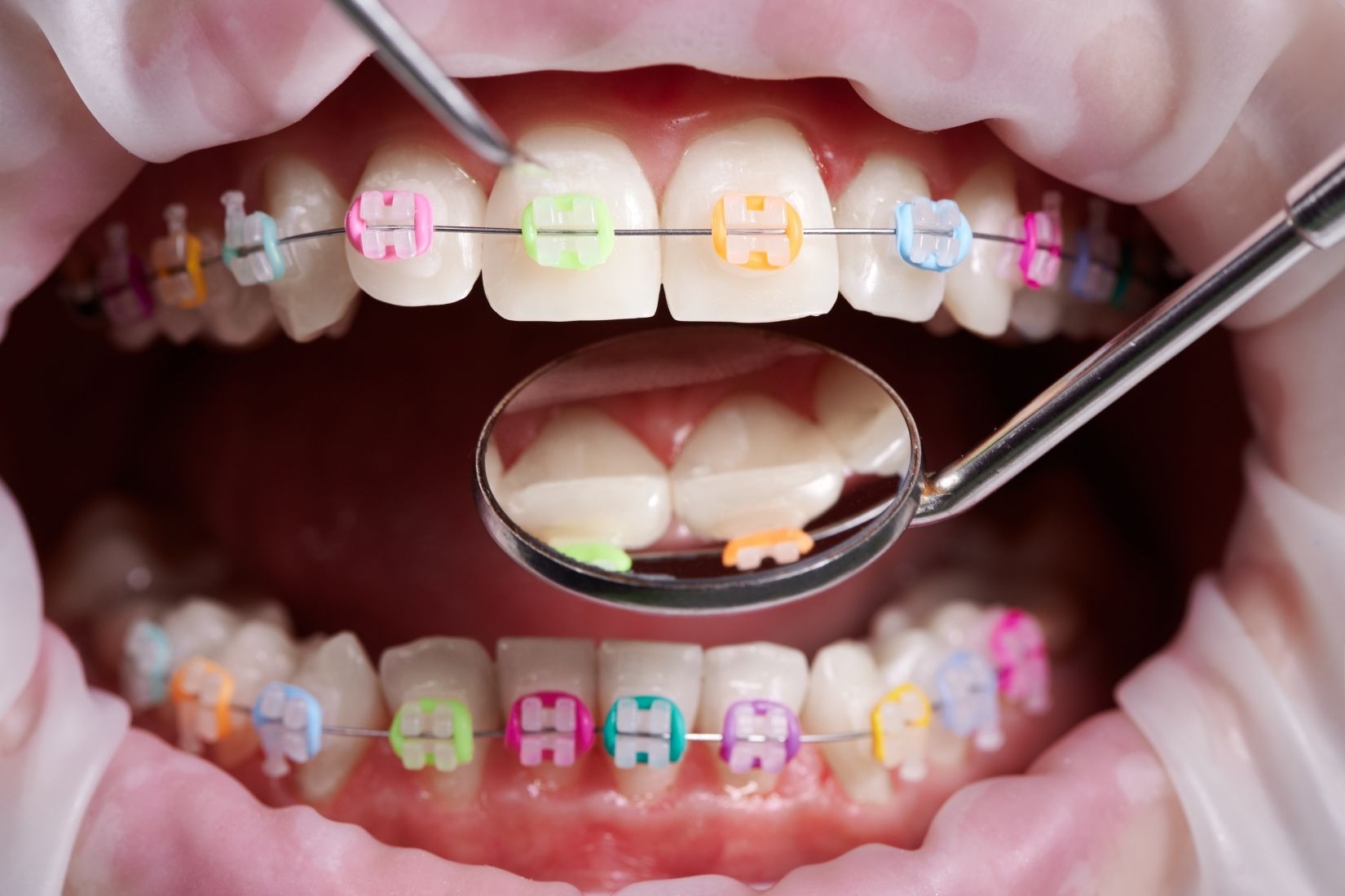 Çocuk diş teli tedavisinde ortodontik muayene ve diş dizilimi değerlendirmesi