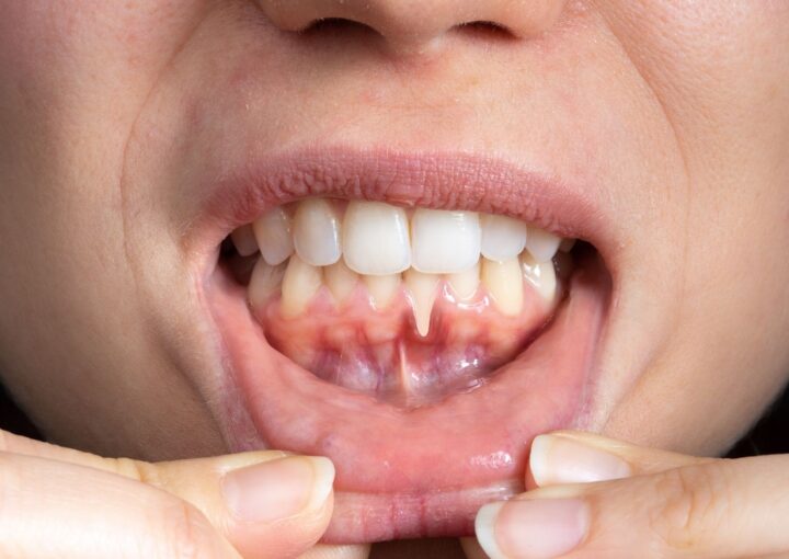 Diş eti sağlığının periodontal muayene sırasında değerlendirildiği ağız içi klinik görünümü.