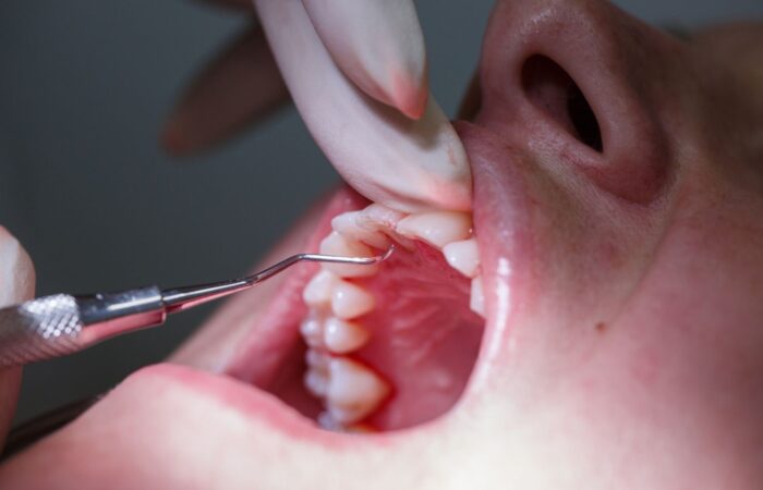 Diyabet ve diş eti sağlığı arasındaki ilişkinin periodontal muayene sırasında değerlendirildiği klinik görünüm.