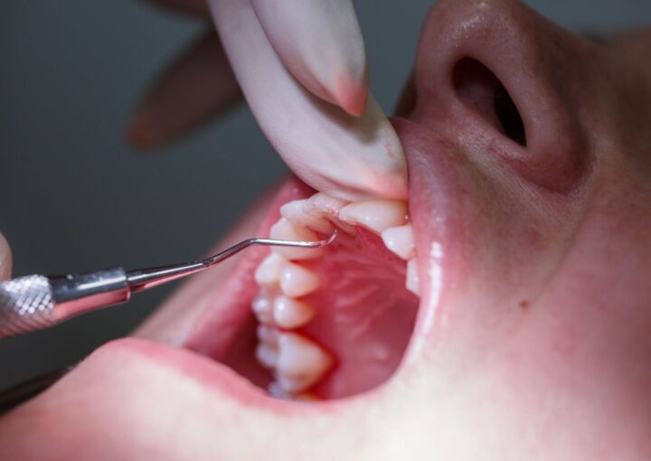 Diyabet ve diş eti sağlığı arasındaki ilişkinin periodontal muayene sırasında değerlendirildiği klinik görünüm.