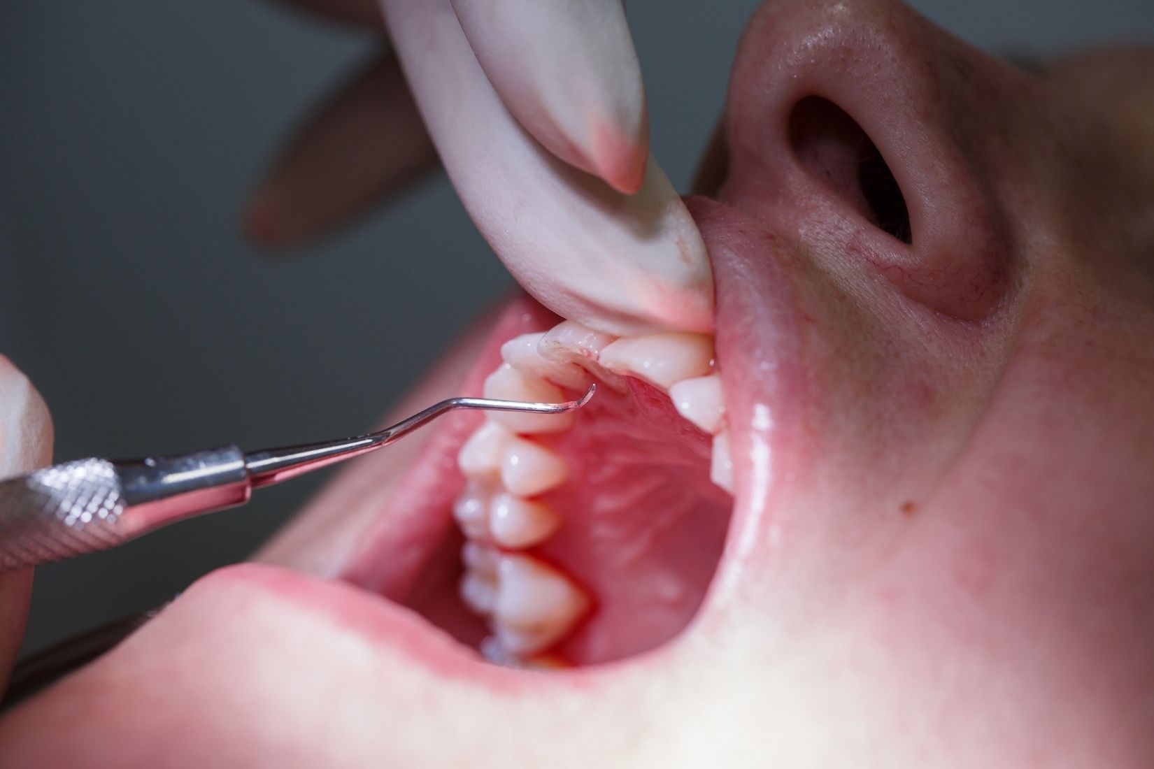 Diyabet ve diş eti sağlığı arasındaki ilişkinin periodontal muayene sırasında değerlendirildiği klinik görünüm.