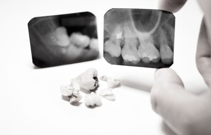 Gömülü dişin çene kemiği içindeki konumunun radyografik ve klinik olarak değerlendirildiği ağız cerrahisi görseli.