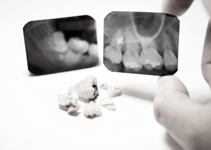Gömülü dişin çene kemiği içindeki konumunun radyografik ve klinik olarak değerlendirildiği ağız cerrahisi görseli.
