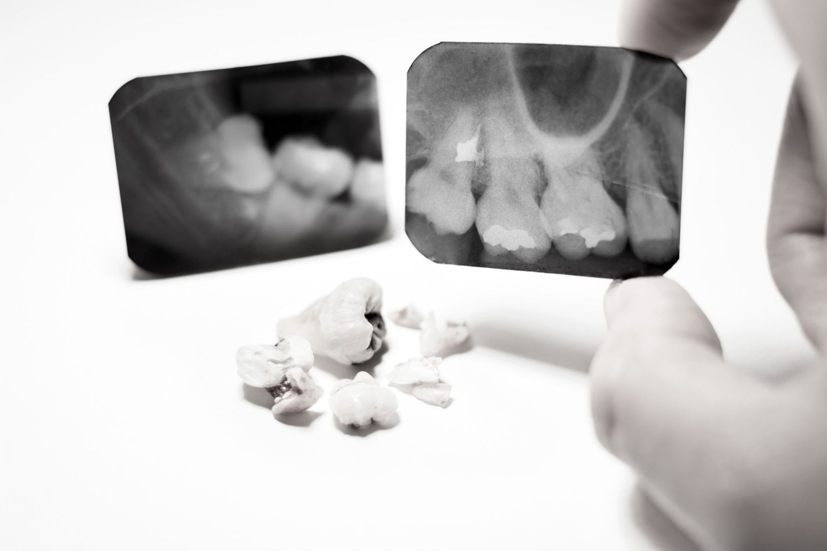 Gömülü dişin çene kemiği içindeki konumunun radyografik ve klinik olarak değerlendirildiği ağız cerrahisi görseli.
