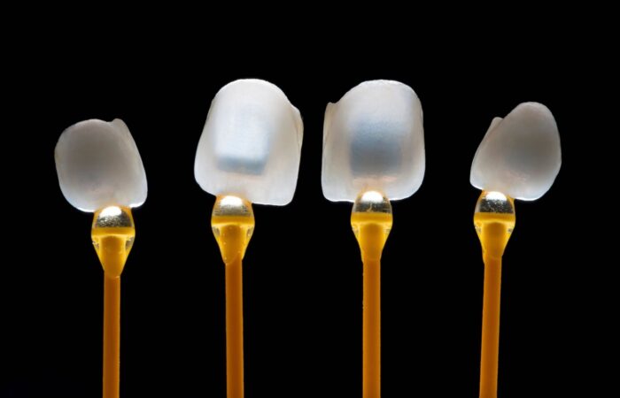E-Max tam seramik restorasyonla dişin renk, form ve yapısının değerlendirilmesini gösteren bilgilendirici dental görsel.