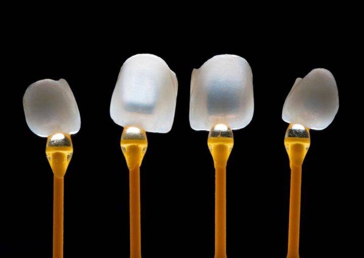 E-Max tam seramik restorasyonla dişin renk, form ve yapısının değerlendirilmesini gösteren bilgilendirici dental görsel.