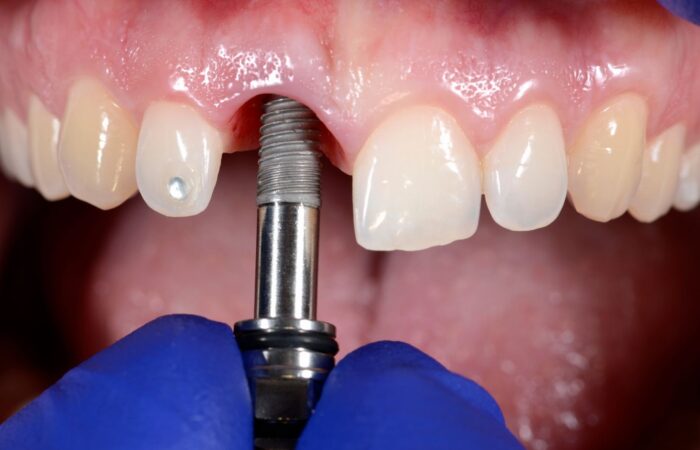 Dental implant öncesinde çene kemiğinin yüksekliği, genişliği ve anatomik yapıların üç boyutlu olarak değerlendirildiği dental görsel.