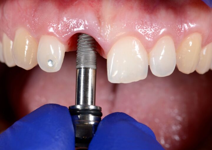 Dental implant öncesinde çene kemiğinin yüksekliği, genişliği ve anatomik yapıların üç boyutlu olarak değerlendirildiği dental görsel.